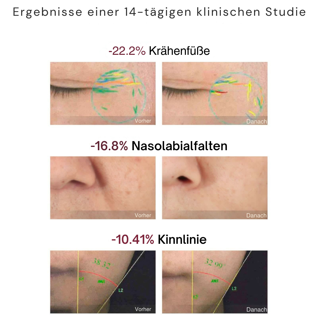 Helvora™ Anti-Aging Gerät R1 Pro – Radiofrequenz, Mikrostrom & LED